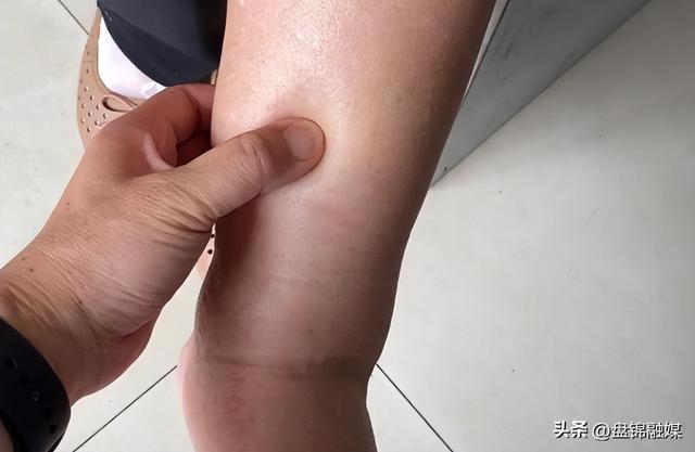 腿部就是你的“血糖仪”,若频繁有这6种症状,多半是血糖超标了