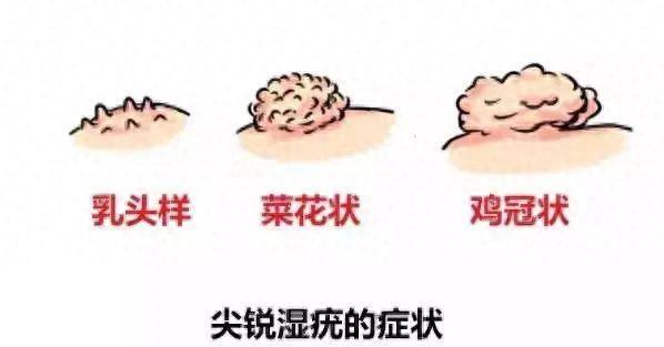 45岁男子生殖器长出“菜花”，在医院他懊悔不已：几年前为何不重视！