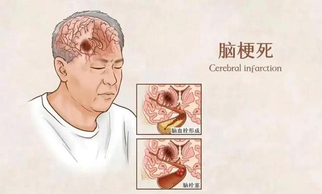上海交大解剖300名脑梗死者，惊讶发现患脑梗的人，有几大共性