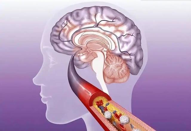 上海交大解剖300名脑梗死者，惊讶发现患脑梗的人，有几大共性