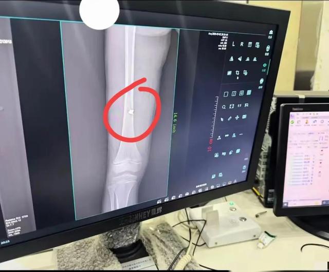 贵州女童引爆手榴弹后续，弹片当场炸入骨，知情人发声，官方回应