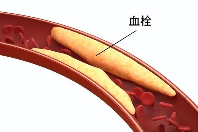 研究发现：西红柿可以在24小时内溶解血栓扩张血管，这是真的吗？