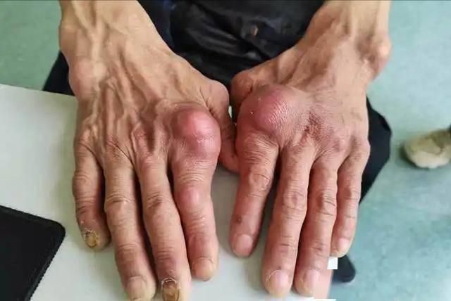 “高尿酸凶手” 被揪出，是动物内脏的数倍！医生：很多人每天都吃