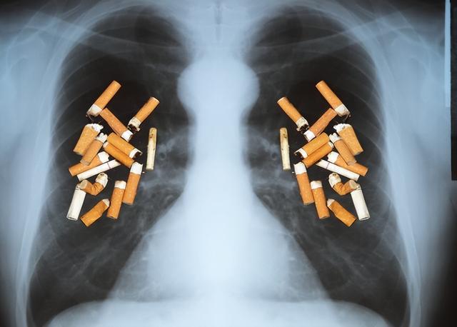 医生解剖80名肺癌死者，研究发现：患肺癌的人，有6大共性！