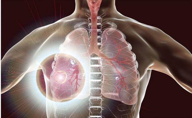 医生解剖80名肺癌死者，研究发现：患肺癌的人，有6大共性！