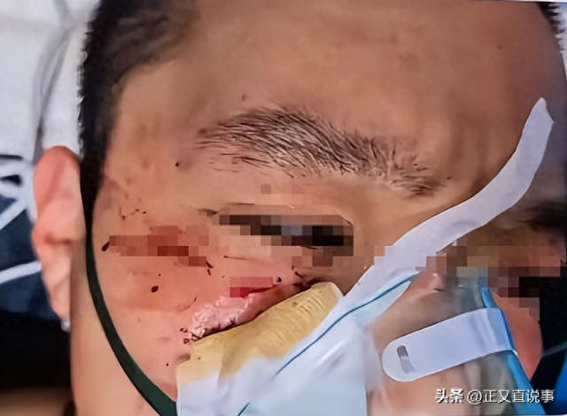 外籍留学生打人后续：已被拘留，身份曝光引争议，被打者靠近毁容