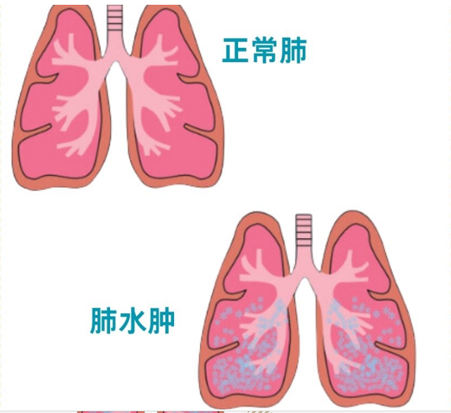夫君抵达三天高反去世

亡！不是洗浴输液，而是多数人犯的致命运动！
