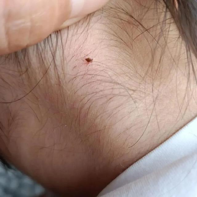 孩子脖子惊现蜱虫，妈妈“两谢绝
”救了娃，年夜
夫：记着三点可救命
