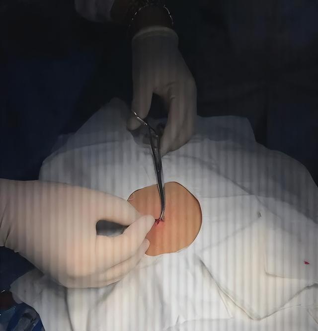 孩子脖子惊现蜱虫，妈妈“两谢绝
”救了娃，年夜
夫：记着三点可救命